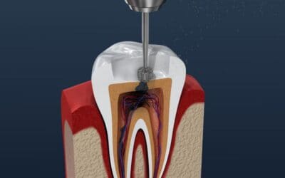 ¿Qué es una endodoncia dental y cuánto cuesta? – México