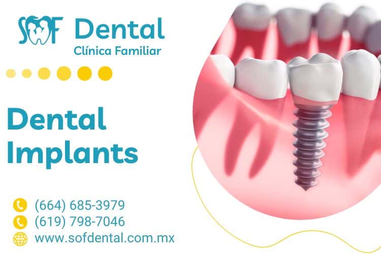 Dental Implants in Tijuana