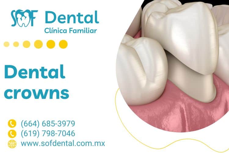 Dental Crowns in Tijuana