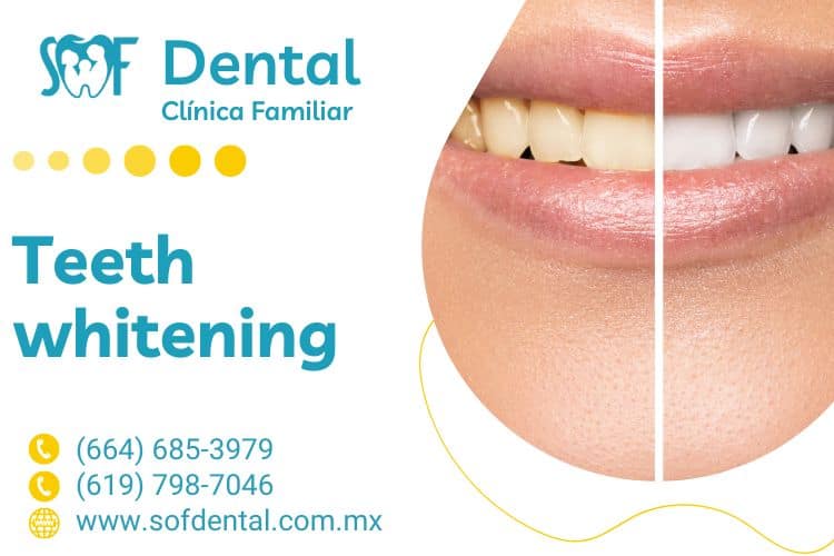 Tooth whitening SOFDental Clinic