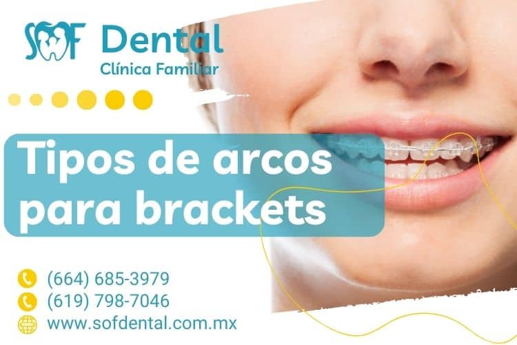 sofdental tipos de arcos para frenos dentales tijuana